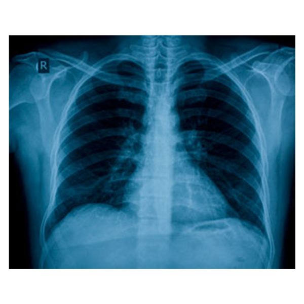 Medical X-Ray Film